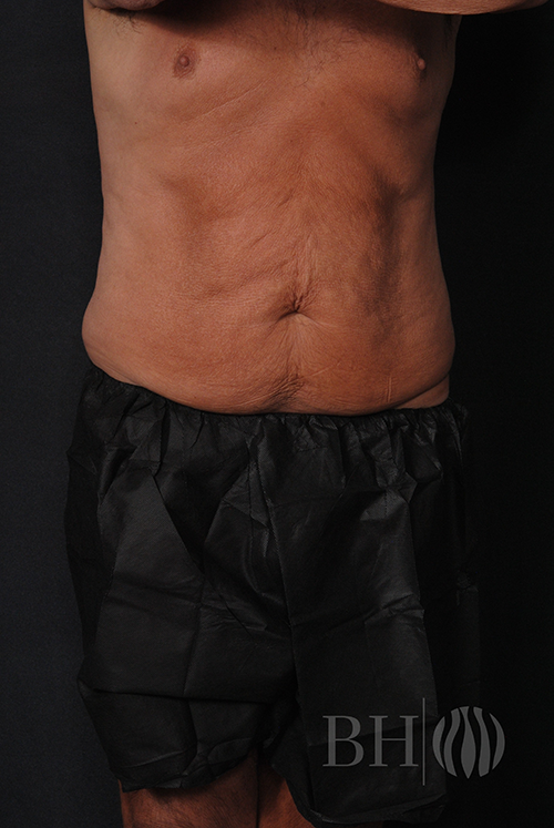 Breast Augmentation With Lift Before & After